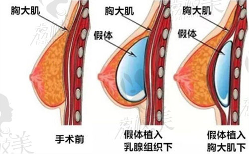 當(dāng)代牙祖蒙做胸技術(shù)怎么樣？