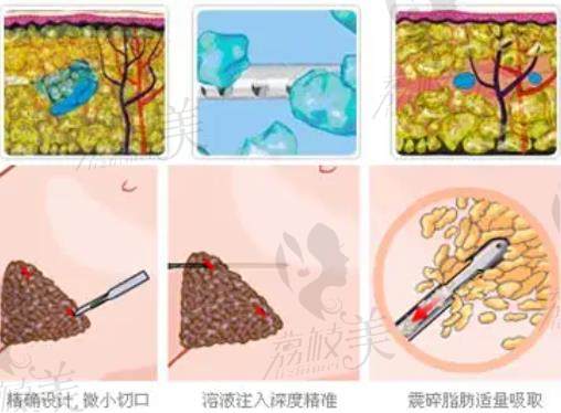 武汉艺星杨斐吸脂怎么样