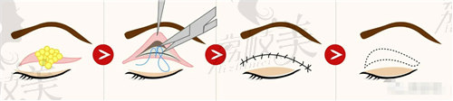 沈国雄医生做双眼皮是哪种风格？