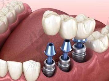 多颗牙齿缺失种植过程
