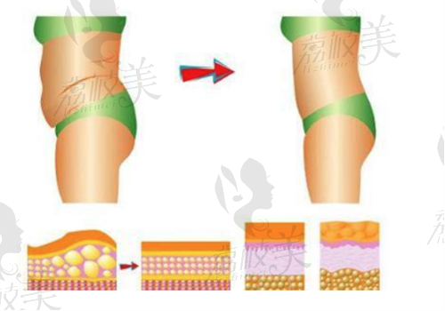 寧波美萊醫(yī)院吸脂圖