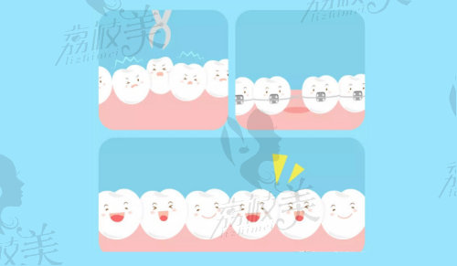 牙齿矫正拔牙4颗几乎没有危害