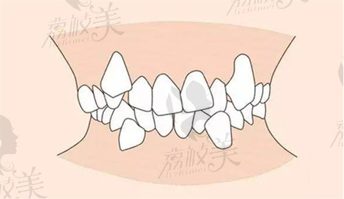 重度牙齿拥挤需先拔牙后矫正