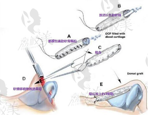 深圳美萊梁曉健院長軟糖鼻包裹過程