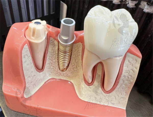 北京劲松口腔医院五棵松院牙齿模型