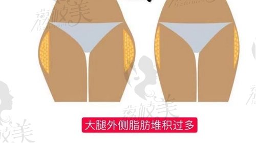 郑州华领徐刚强医生大腿吸脂手术怎么样？