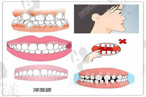 牙齿矫正适应症