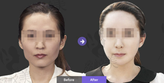 韩国neo整形外科 面部轮廓