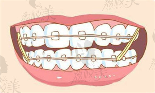 廣州柏德口腔醫(yī)院牙齒矯正多少錢