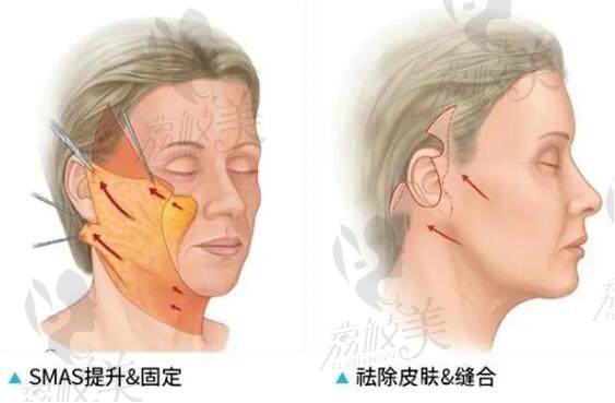 北京面部提升专科医院有哪些？