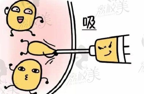 郑州毋磊医生特色面吸技术