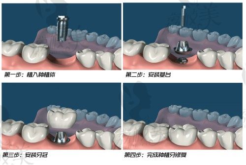 南京微芽口腔孟凯医生种植牙过程
