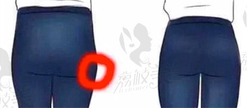 西安大腿環(huán)吸價(jià)格多少錢(qián)？