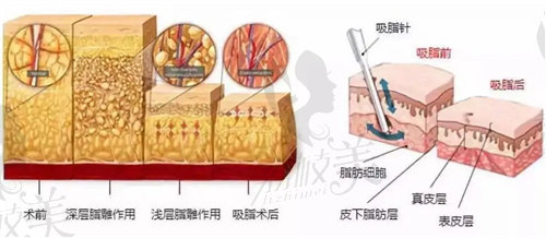 王仁根吸脂多錢(qián)？