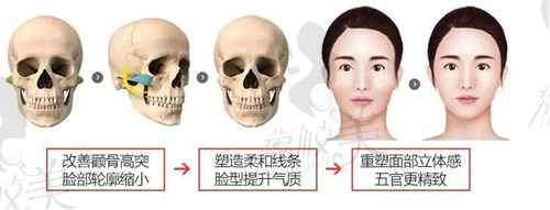 南京友谊整形吴国平做颌面手术技术娴熟