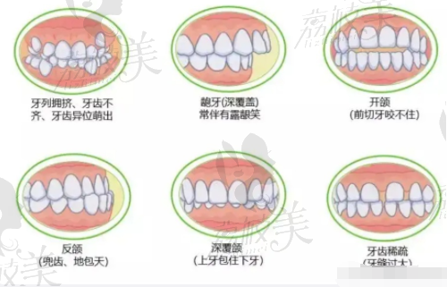 广州地包天矫正的类型