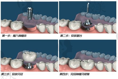 韩国登腾种植牙质量怎么样