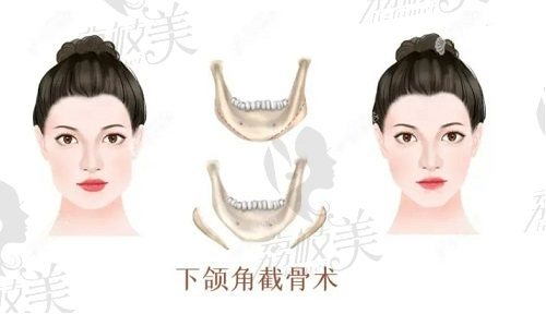四川现代医院刘黎明下颌角磨骨技术怎么样？