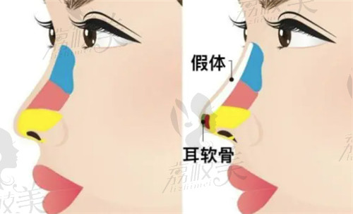 上海艺星医疗美容医院隆鼻价格表
