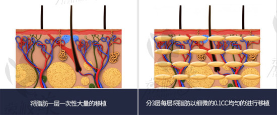 韓國(guó)歐佩拉整形醫(yī)院 脂肪移植