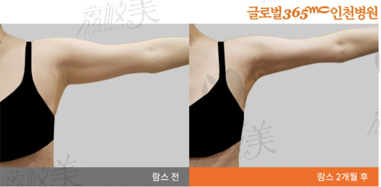 韩国365mc 手臂吸脂对比图