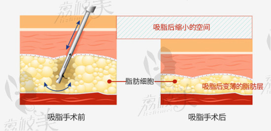 韩国欧佩拉 吸脂手术原理