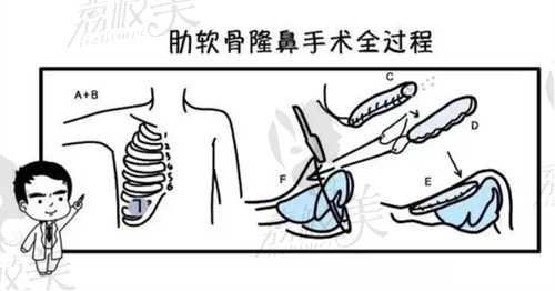 南京美贝尔陈刚医生隆鼻口碑不错