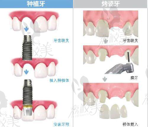 烤瓷牙和種植牙的差異