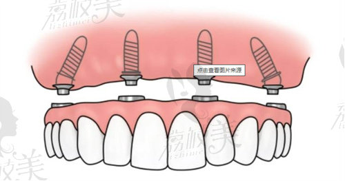 北京科尔口腔医院种一颗牙多少钱