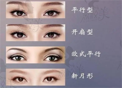 杭州时光双眼皮类型图