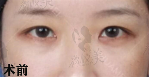 西安画美李小正做双眼皮修复怎么样？