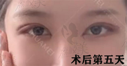 西安画美李小正做双眼皮修复术后实例