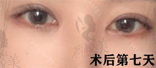 西安画美李小正做双眼皮修复术后第七天