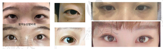 韩国大眼睛 眼整形对比图
