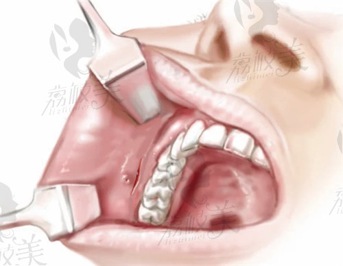 下颌角长曲线截骨手术是什么？