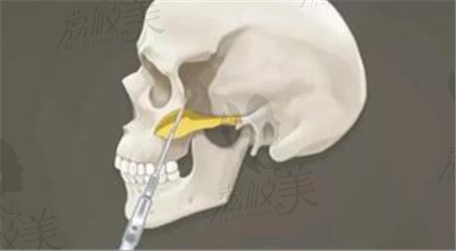 罗延平医生做颧骨颧弓整形手术的技术好