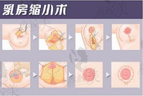 广州缩胸手术一般多少钱