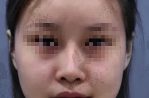 在南京美贝尔做隆鼻手术前