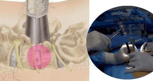 韩国李承哲显微颈椎间盘切除术和接骨术