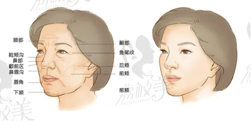 南京黄名斗医生自体脂肪面部填充技术高超