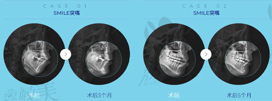 韩国DA整形突嘴手术