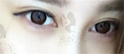 西宁华悦星颜医疗美容双眼皮评价1.jpg