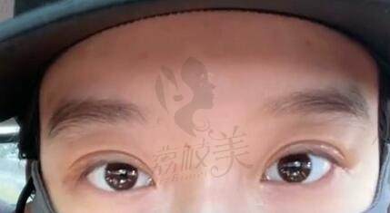 郑志龙医生做双眼皮怎么样？
