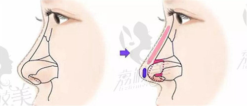 青岛博士医疗美容医院做鼻子技术优势