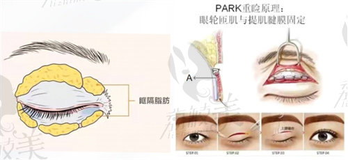 汪阳医生改良PARK法双眼皮技术优势