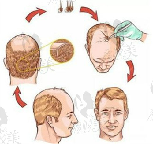 植发过程