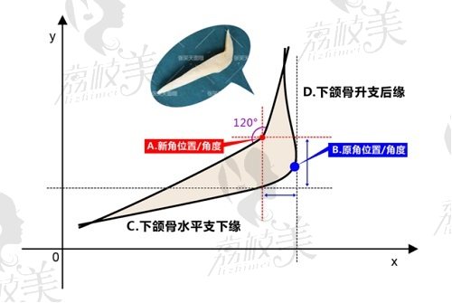 张笑天医生长曲线截骨术优势