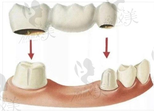 全瓷牙镶嵌稳固