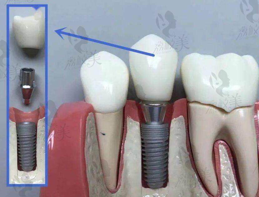 种植牙的结构和适用人群