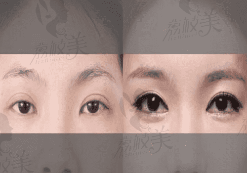  苏州维多利亚端木雪峰双眼皮图